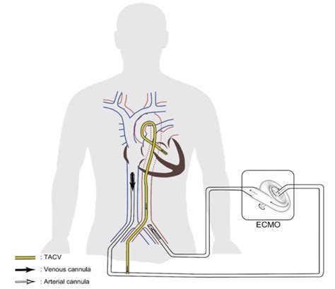 lv vent cannula|va ecmo cannula location.